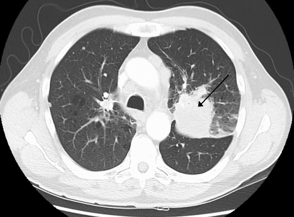 Escáner (tomografía computerizada) de un cáncer de pulmón. Fuente: Lourens Willekes, Cherif Boutros and Michael A. Goldfarb